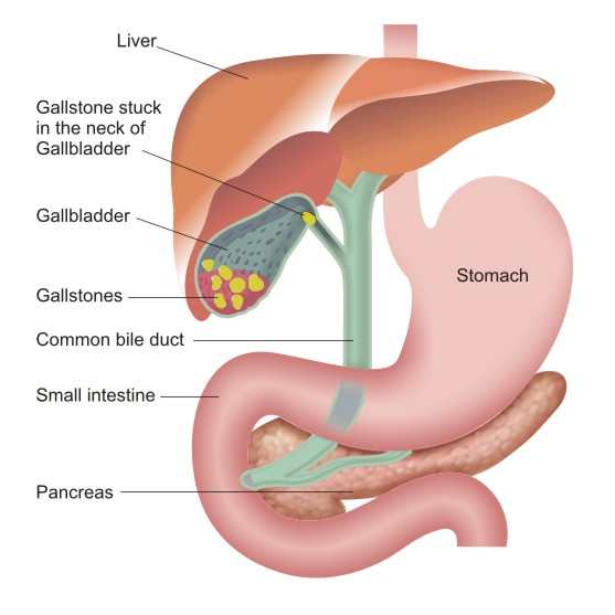 Gallbladder Surgery