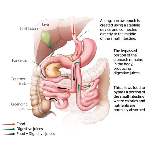 Mini Gastric Bypass
