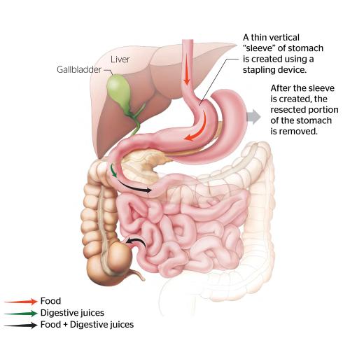 Gastric Sleeve